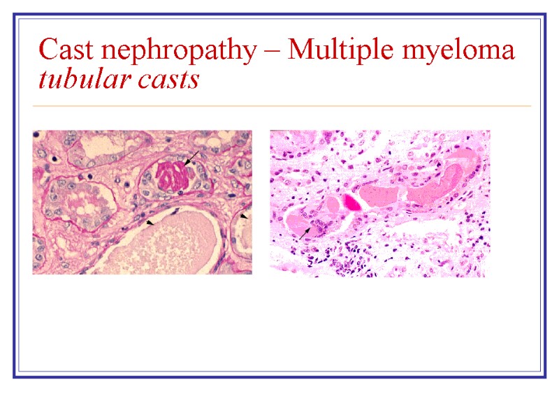 Cast nephropathy – Multiple myeloma tubular casts